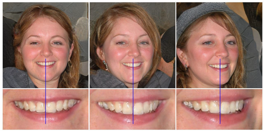Teeth generated facing forward regardless of face orientation